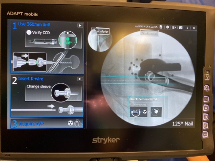 RIVOLI - Primi due interventi al femore con una tecnologia innovativa